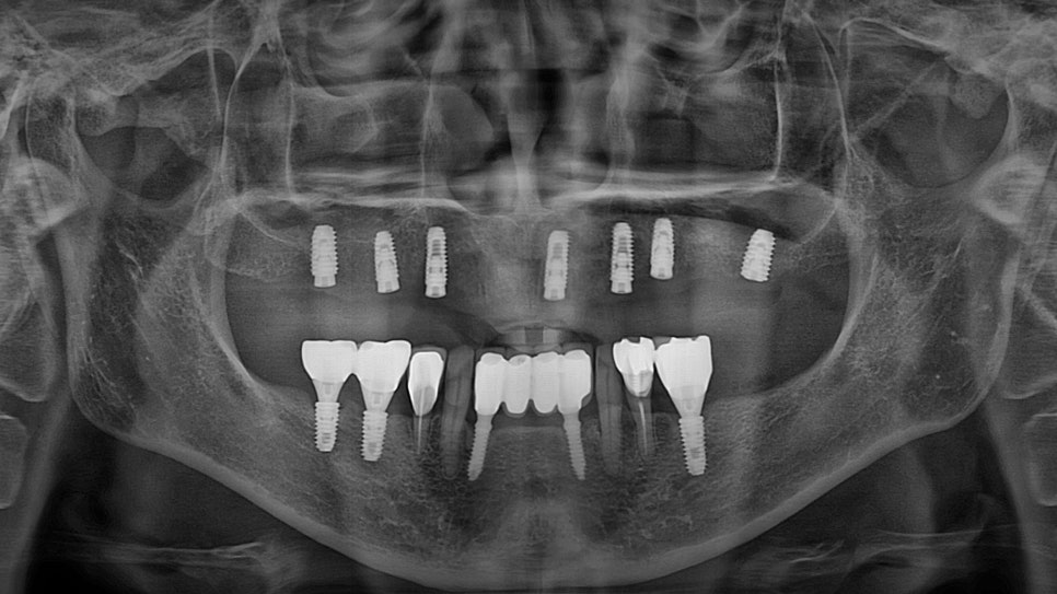 Songpa Station Dentist: Have You Been Using Dentures for a Long Time? <Digital Guided Implants> image 9