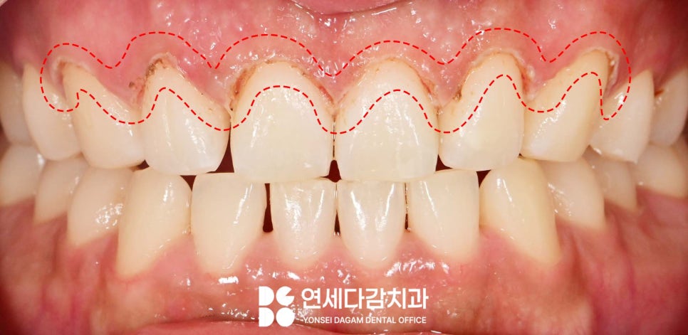 연세다감치과 심미 치료 무삭제 라미네이트 통해 자신감 있는 미소를 되찾는 여정 관련 이미지 5