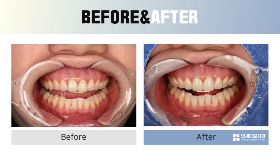 Songpa-dong Dentist: It Wasn’t Just the Front Crown That Was Replaced! A retreatment case that also considered the gum line image 7