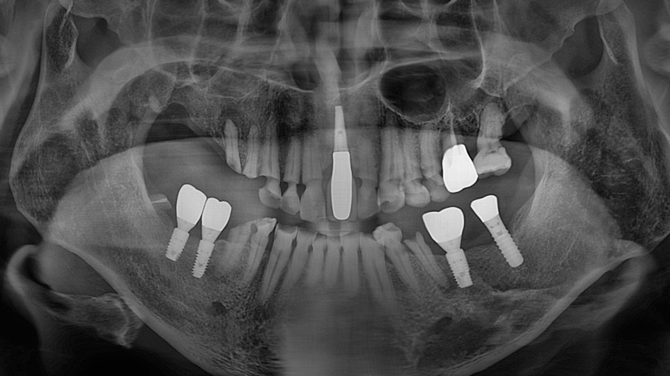 Munjung-dong Dentist: What Does Tooth Attrition Mean, What Are Its Symptoms, and How Is It Treated? image 5