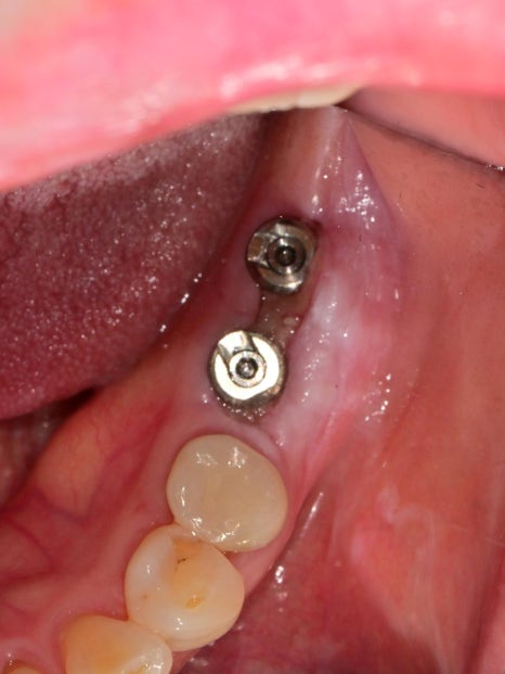 Munjeong-dong Dental Clinic, Bone Graft Implant Process&middot; What If You’ve Lost a Molar? image 9