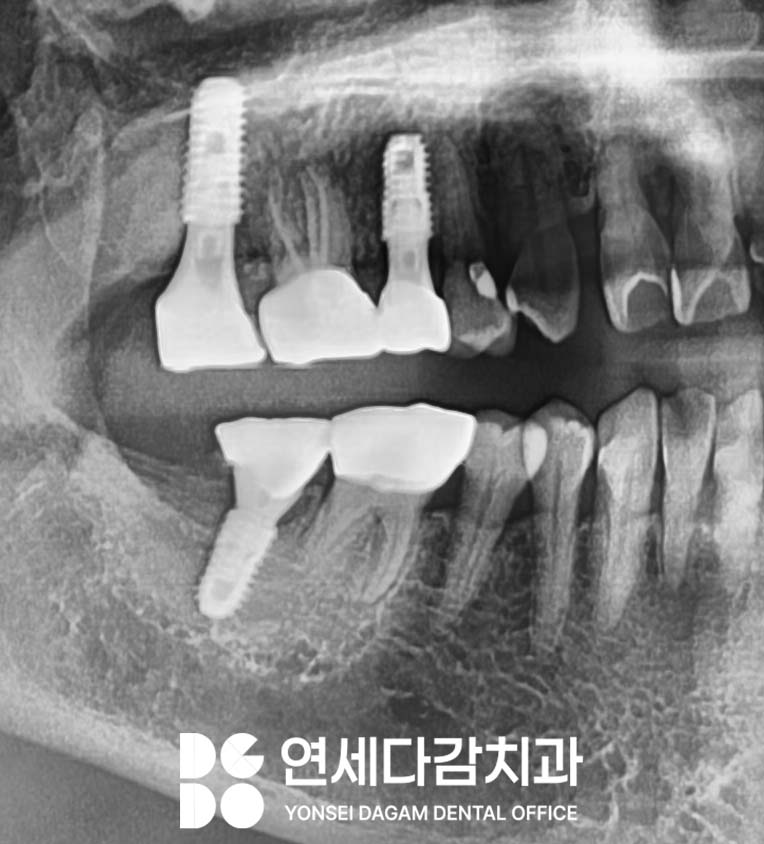 임플란트 재수술 가락동 치과 정밀한 분석과 전략적 접근 통한 치유 과정 관련 이미지 8