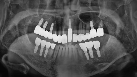 Munjung-dong Dentist: What Does Tooth Attrition Mean, What Are Its Symptoms, and How Is It Treated? image 11