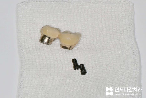 오래된 임플란트 다시 수술하지 않고 크라운 교체만 가능할까 문정동 치과 SCRP 타입으로 보철 재제작 관련 이미지 5