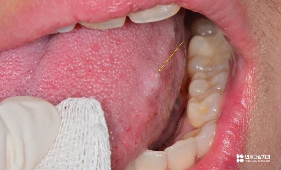 A Bump on the Side of the Tongue: From the Appearance of Oral Papilloma to Treatment | Gaerong Station Dental Clinic image 2