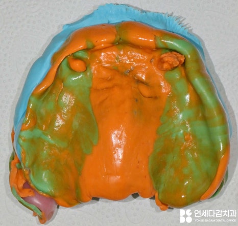 항암 치료 전 발치 필요할 때 기존 부분틀니 송파동 치과 에서 보철 수정 후 임시로 완전틀니 만든 이유 관련 이미지 6