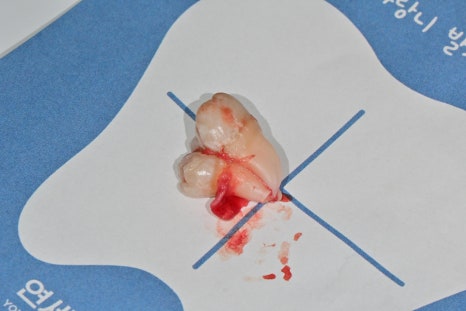 Garak-dong Wisdom Tooth Extraction: What If Two Wisdom Teeth Grew Fused Together? [A Case of Fused Wisdom Tooth Extraction] image 7