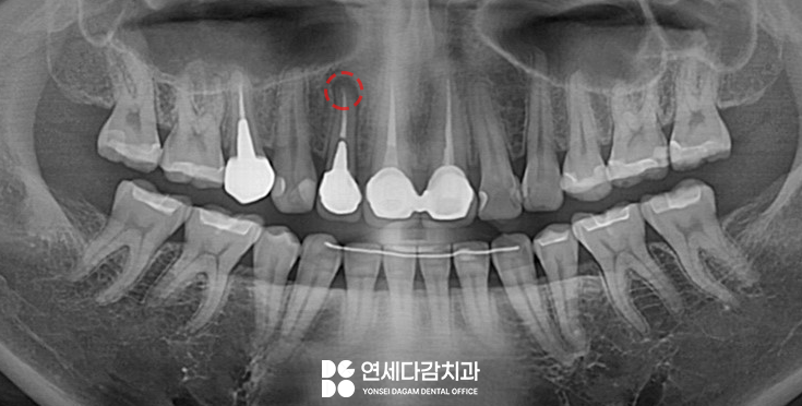 치아 발치를 피하기 위한 마지막 수단 MTA 이용한 가락동 치과 치근단 절제술 과정 살펴봅시다. 관련 이미지 8