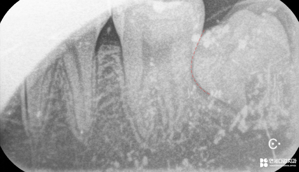 가락동 치과 교정 치료 전 사랑니 발치 꼭 필요할까? - 미성숙 매복케이스로 알아보는 과정 관련 이미지 7