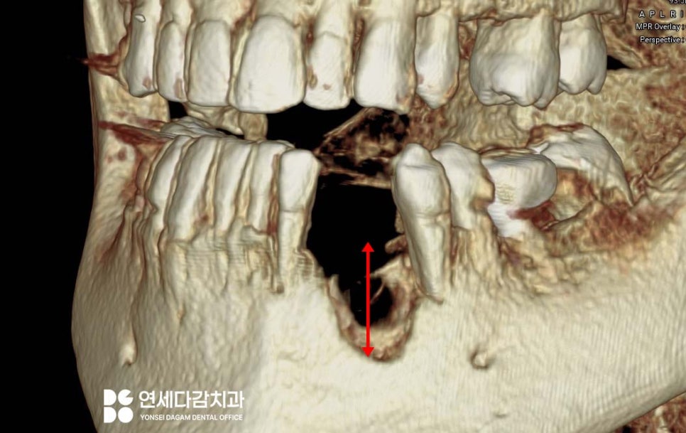 심한 골소실에도 임플란트 가능할까요 가락시장역 치과 뼈이식 통한 안정적인 고정력 확보 과정 관련 이미지 2