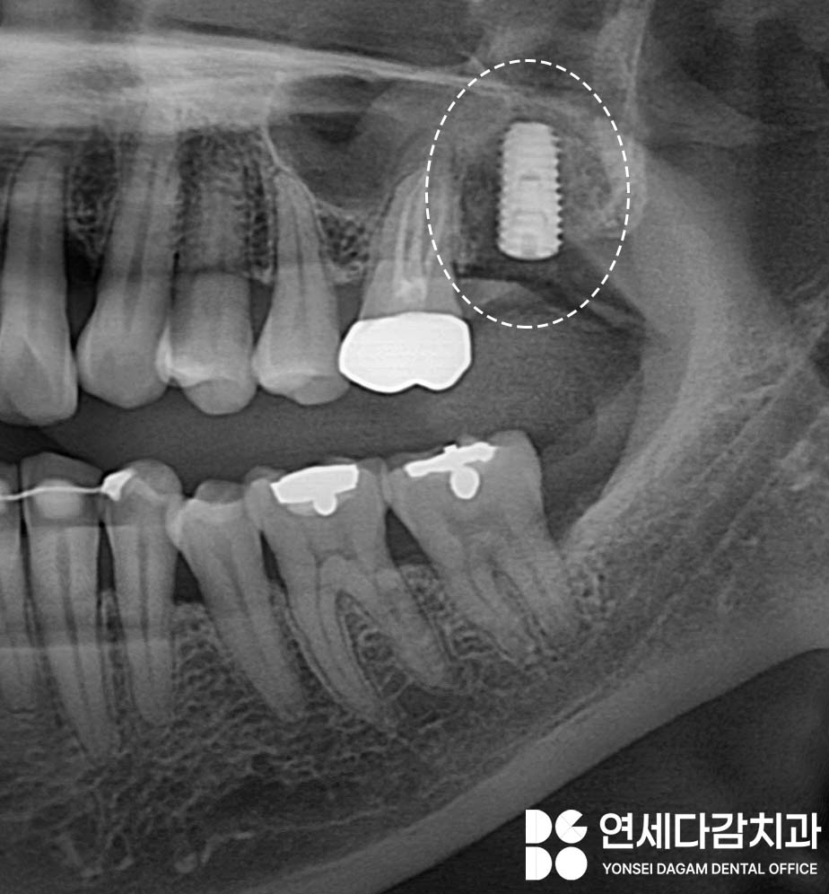 송파구 가락동 치과 공포증 완화 위한 수면마취 임플란트 의식하진정법에 사용되는 미다졸람 특징 및 장점과 부작용에 관한 이야기 관련 이미지 3