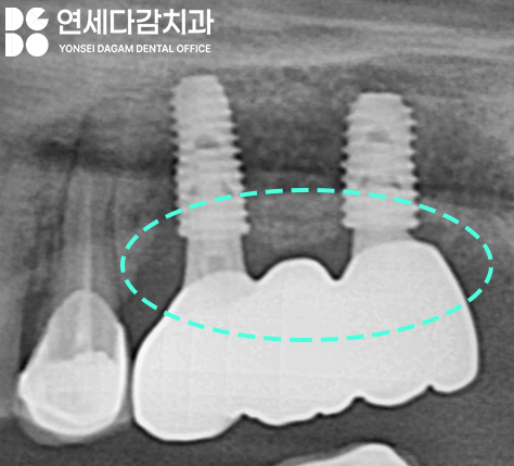 문정역 치과 임플란트 오래 사용하기 위해서 지대주 (어버트먼트) 보철 종류 기성 및 커스텀 지대주 (abutment) 차이 알고 받아야 되는 이유 관련 이미지 8