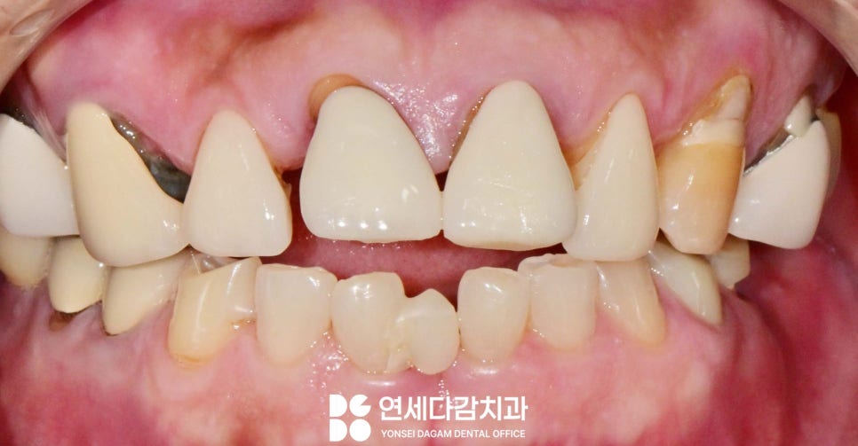 치주염 원인으로 치아 흔들림 오금동 치과 크라운 치료 통해 뻐드러진 앞니 돌출입 해소 과정에서 잇몸치료 필요한 이유 관련 이미지 3