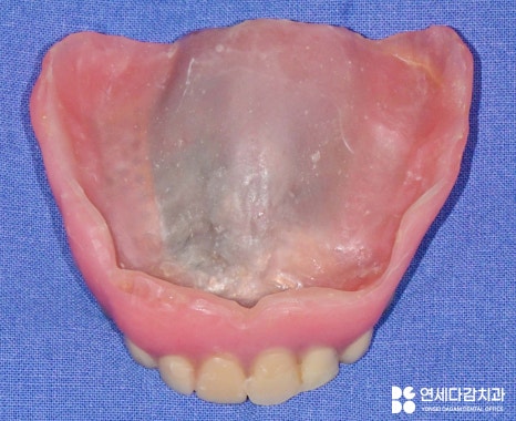 항암 치료 전 발치 필요할 때 기존 부분틀니 송파동 치과 에서 보철 수정 후 임시로 완전틀니 만든 이유 관련 이미지 9