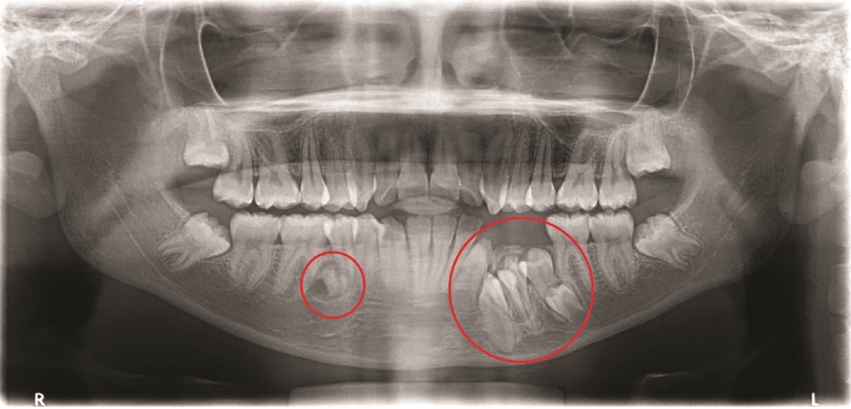 매복과잉치 를 발치할 때 CT 촬영이 필요한 이유? 연세다감치과 의학 정보 전달 글 관련 이미지 1