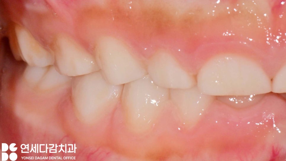 치아 마모 원인 소아 이갈이 치료 꼭 해야 될까 오금역 치과 에서 알아보는 원인과 관찰해야 될 징후들 관련 이미지 2