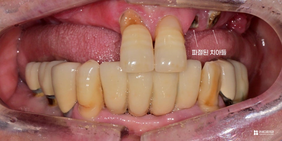 개롱역 치과 치주 질환으로 인한 심한 잇몸뼈 손실 - 네비게이션 방식 임플란트로 진행된 안전한 치료 관련 이미지 2