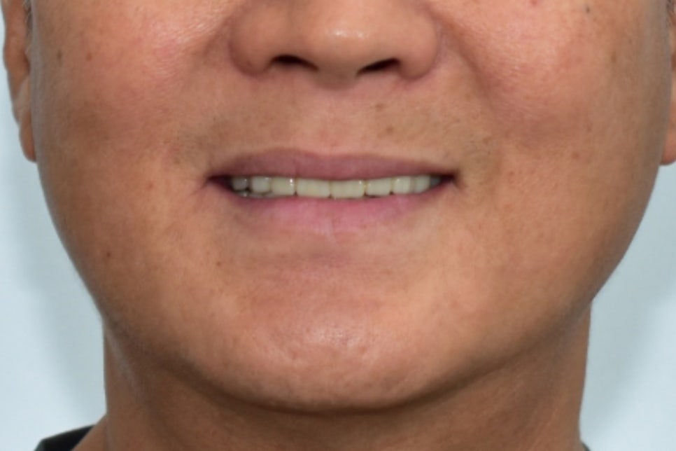 Munjeong-dong Full-Mouth Dental Implants: Why Did the Patient’s Appearance Change After Simply Replacing the Teeth? image 11