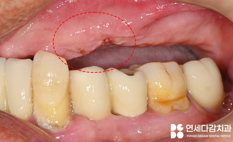 불편한 틀니 임플란트로 바꿔 치료할 수 있을지 가락시장역 치과 에서 살펴봅시다. 관련 이미지 4