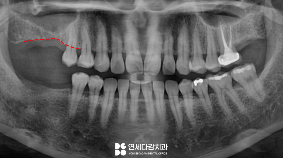 발치 후 생기는 잇몸뼈의 변화로 임플란트 과정이 복잡해질 수 있습니다 경찰병원역 치과 에서 알아보는 상악동 거상술. 관련 이미지 1