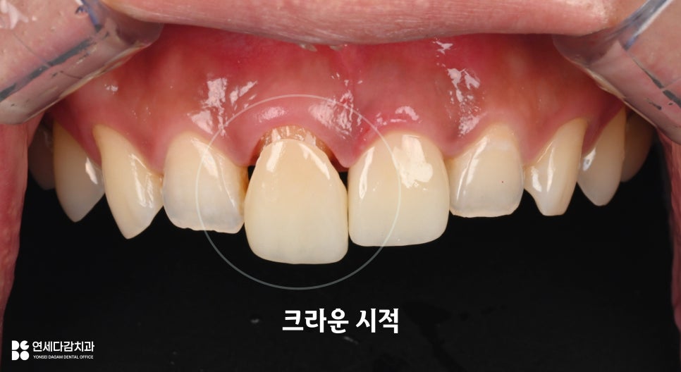 송파구 치과 앞니 하얗기만 하면 예쁠까요? 자연스러운 심미보철이 만드는 차이 관련 이미지 5