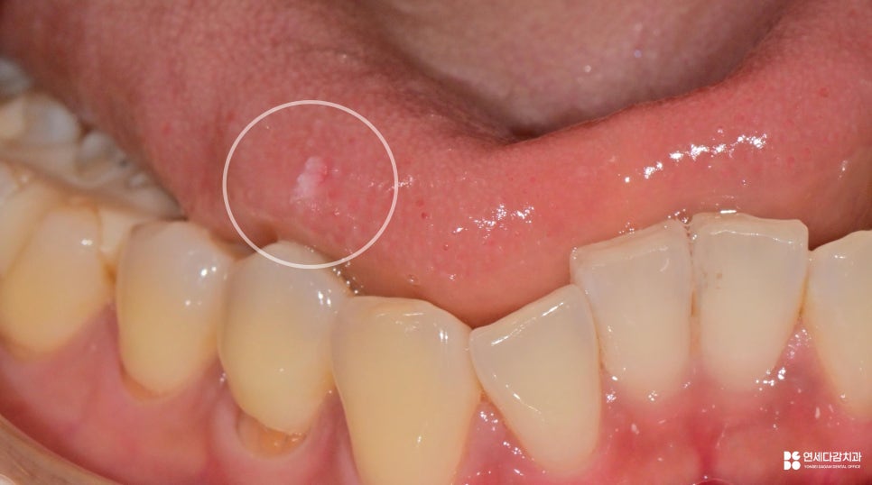개롱역 치과 혀에 하얀 돌기? 구강 유두종 작아도 조직검사가 필요한 이유 관련 이미지 4