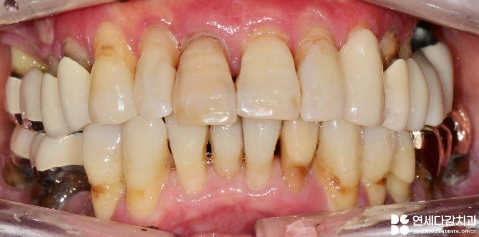 잇몸이 붓고 피나고 냄새날 때 송파역 치과 구강암 증상과 비슷한 급성 궤양성 치은염 (ANUG) 잇몸치료 통한 치주질환 개선 관련 이미지 6