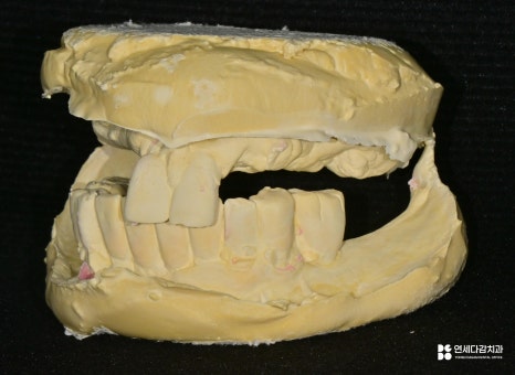 개롱역 치과 치주 질환으로 인한 심한 잇몸뼈 손실 - 네비게이션 방식 임플란트로 진행된 안전한 치료 관련 이미지 5