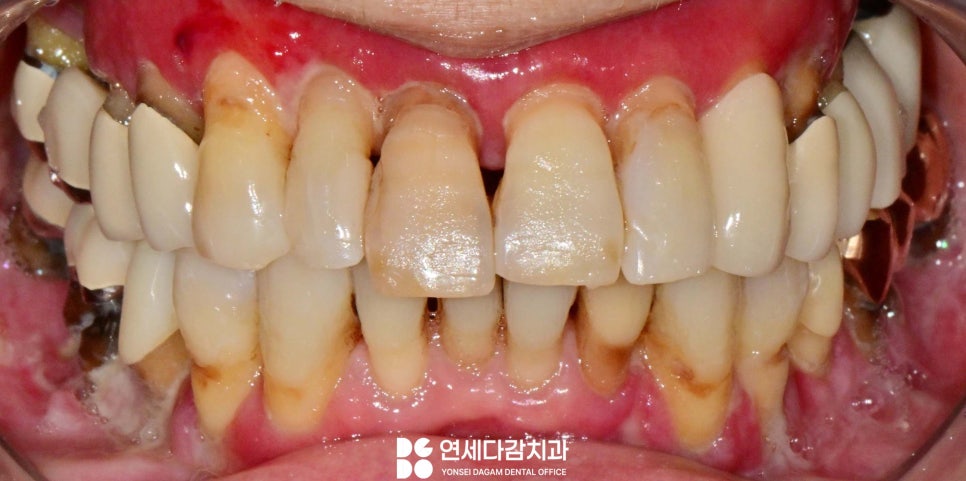 잇몸이 붓고 피나고 냄새날 때 송파역 치과 구강암 증상과 비슷한 급성 궤양성 치은염 (ANUG) 잇몸치료 통한 치주질환 개선 관련 이미지 1