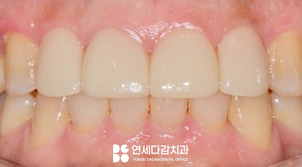 송파동 치과 앞니 사이 벌어짐 라미네이트 부분적으로 가능할까? 관련 이미지 5