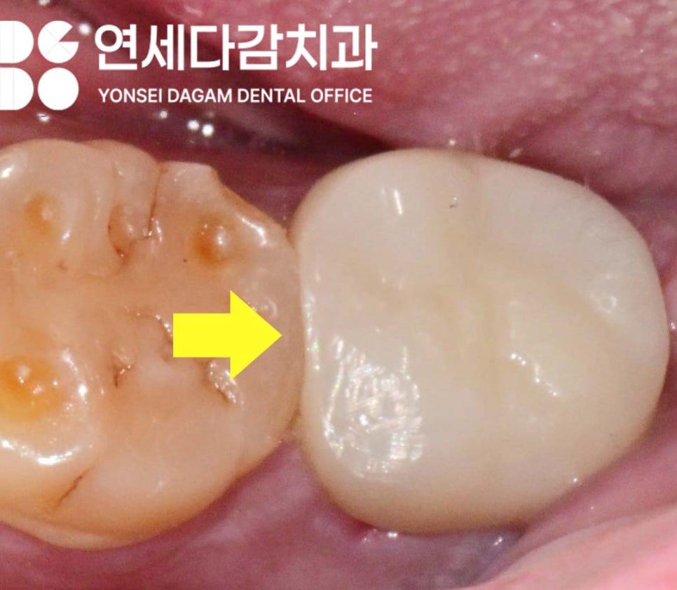 어금니 깨짐, 치아에 금 갔을 때 찌릿한 통증 가락시장역 치과 신경치료 후 크라운 꼭 씌워야 되는 이유와 예방법 관련 이미지 4