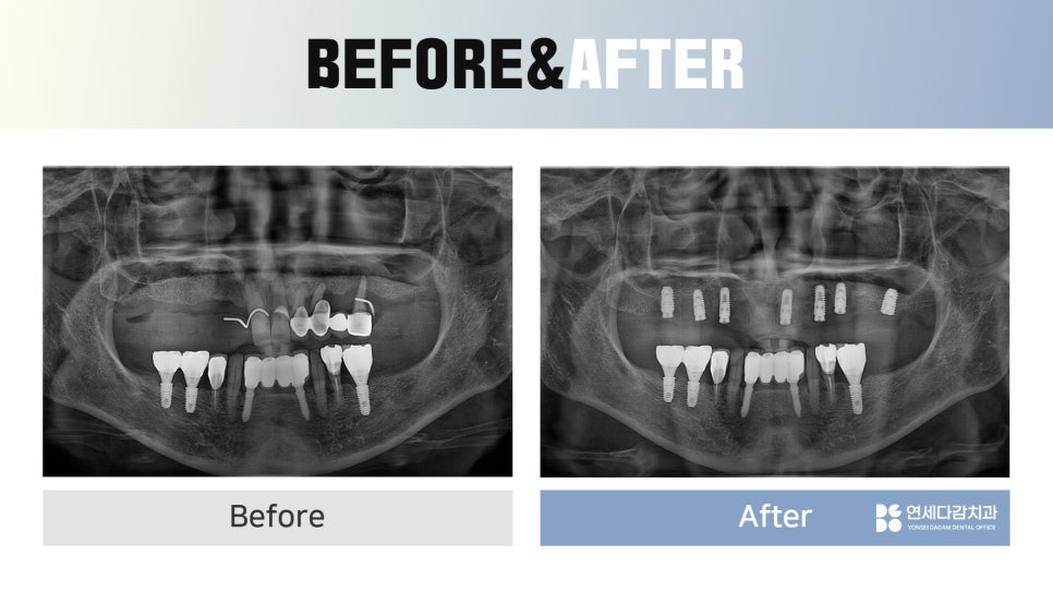Songpa Station Dentist: Have You Been Using Dentures for a Long Time? <Digital Guided Implants> image 10
