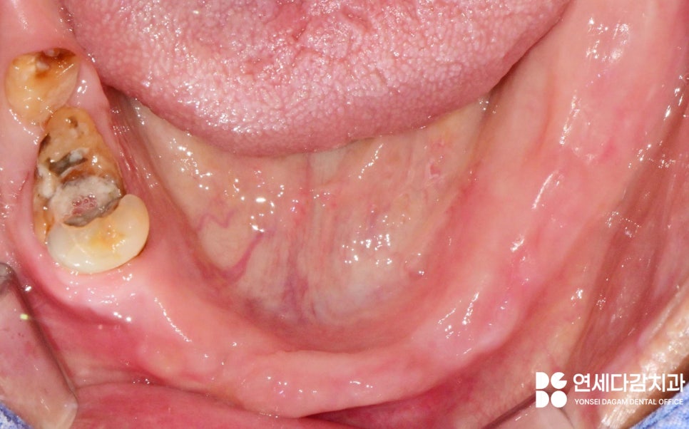 항암 치료 전 발치 필요할 때 기존 부분틀니 송파동 치과 에서 보철 수정 후 임시로 완전틀니 만든 이유 관련 이미지 4