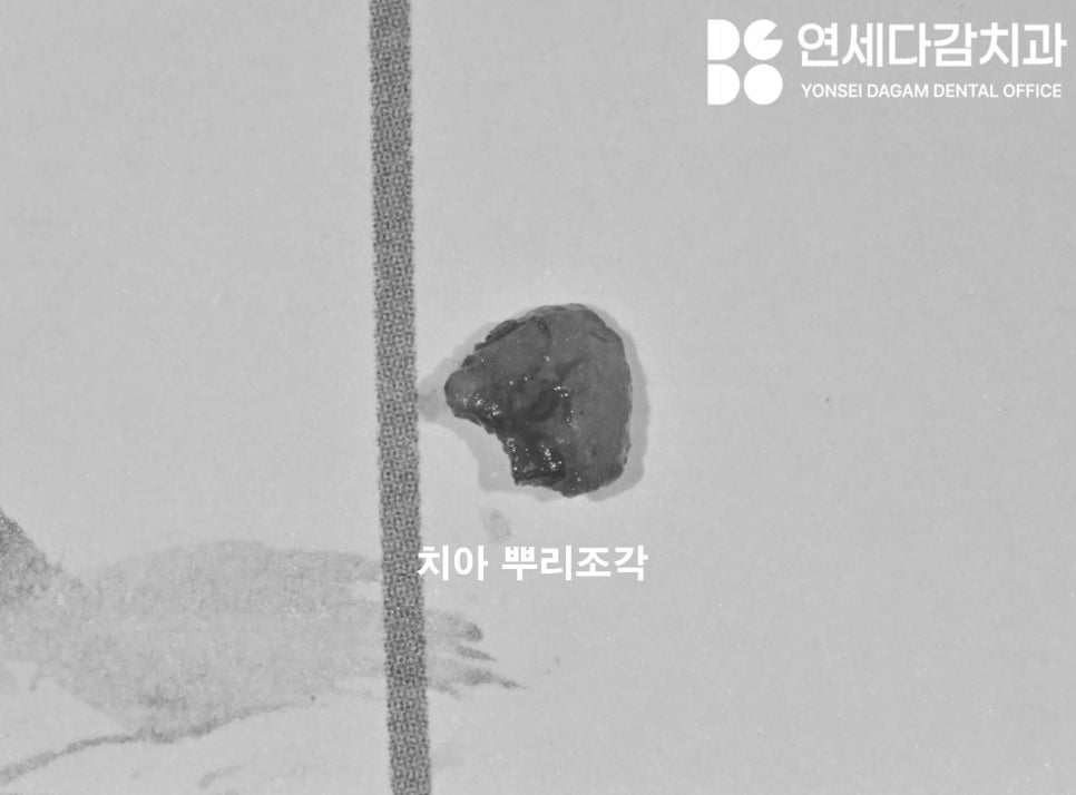 If the gums keep swelling and pus keeps coming out after impacted wisdom tooth extraction, how to find tooth root fragments remaining in the jawbone at a dental clinic in Songpa District image 4