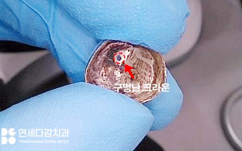 크라운 빠졌을 때 다시 붙일 수 있을까 문정동 치과 구강 스캐너 통한 보철 제작 관련 이미지 1