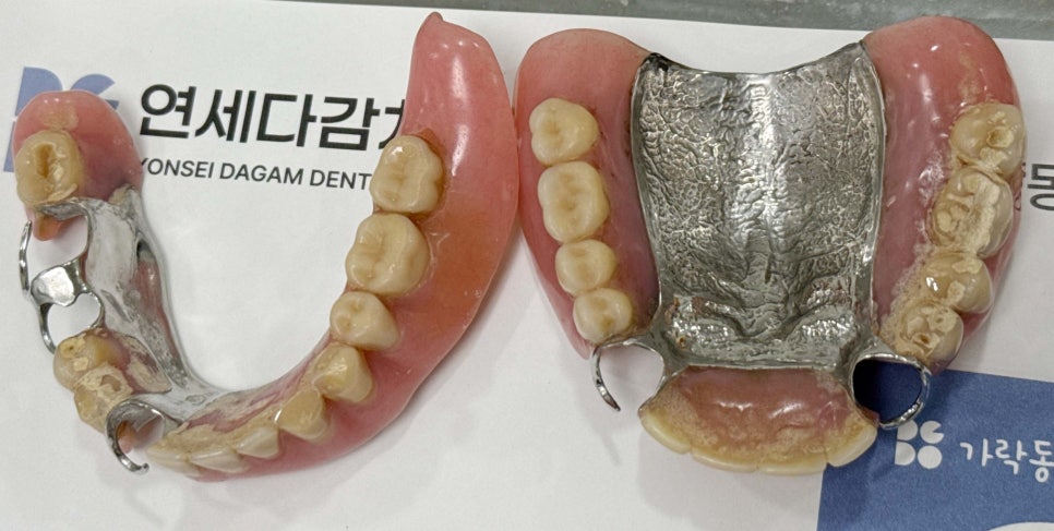 항암 치료 전 발치 필요할 때 기존 부분틀니 송파동 치과 에서 보철 수정 후 임시로 완전틀니 만든 이유 관련 이미지 2