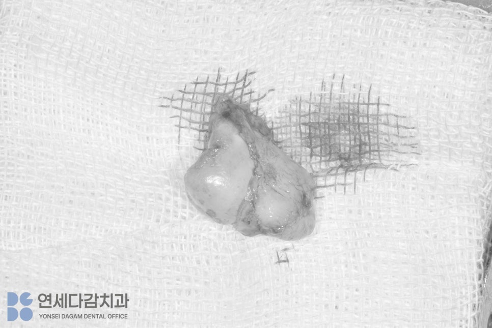 매복 사랑니 발치 시 관련 이미지 5