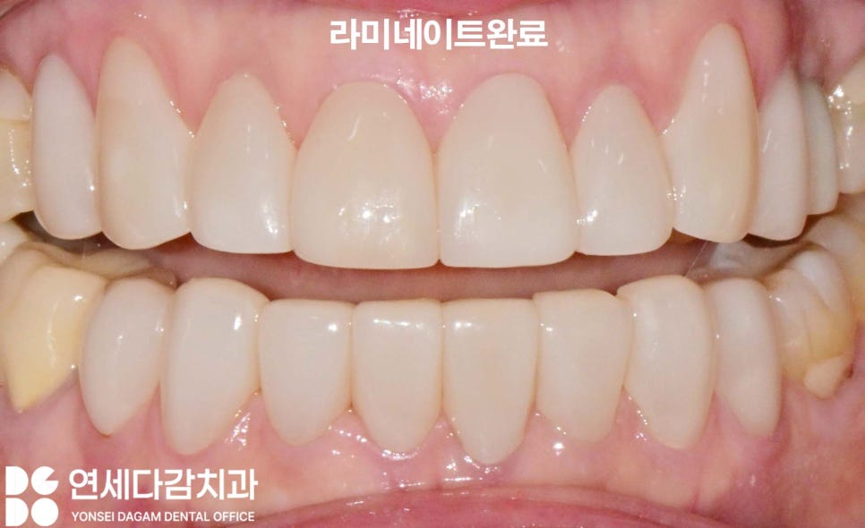 누런이 미백 안 해도 하얀이 원할 때 송파동 치과 최소삭제 라미네이트 과정에서 잇몸 치은 성형술 필요한 이유 관련 이미지 5