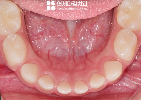 아이가 앞으로 넘어졌을 때 앞니 치료 확인법 거여역 치과 소아 치아 외상의 이해와 관리 관련 이미지 3