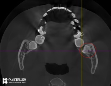 가락동 치과 교정 치료 전 사랑니 발치 꼭 필요할까? - 미성숙 매복케이스로 알아보는 과정 관련 이미지 6