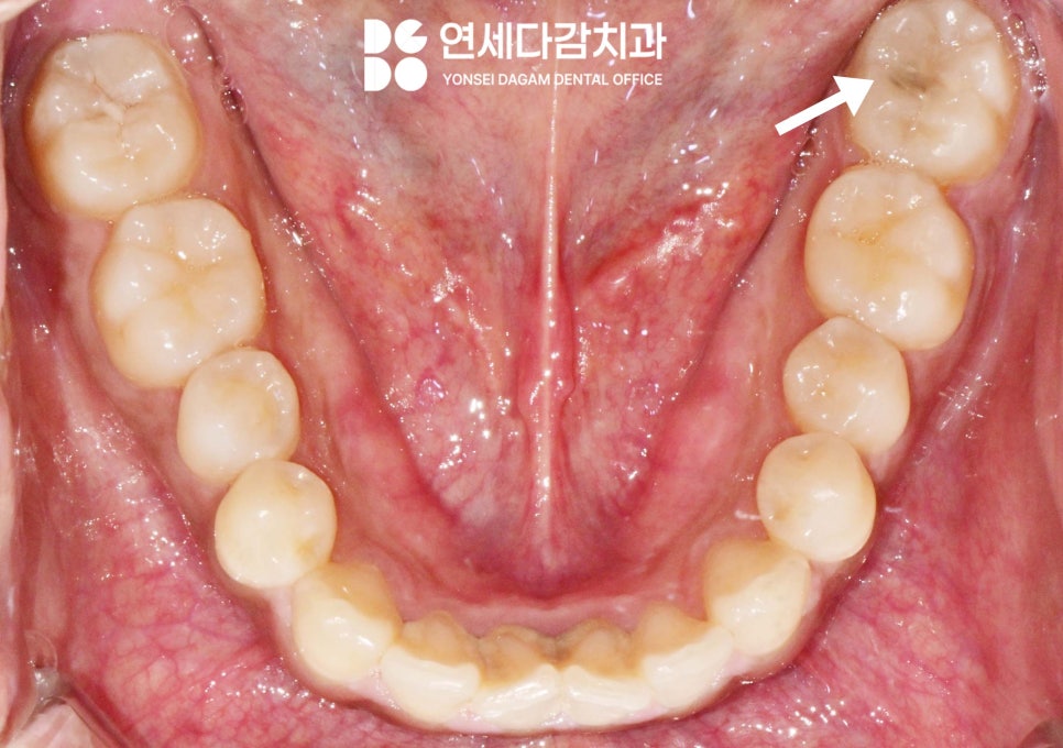 충치 범위에 따른 치료 방법 가락동 치과 레진 또는 인레이 언제 적용할 수 있을까? 관련 이미지 1