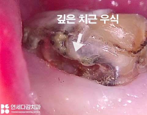 어금니 찌릿한 통증 치아에 금갔을때 신경치료 크라운 가락시장역 치과 충치 깊을 때 당일 발치 임플란트 및 부러진 보철 임플란트재식립 관련 이미지 6