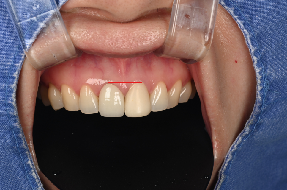 Songpa-dong Dentist: It Wasn’t Just the Front Crown That Was Replaced! A retreatment case that also considered the gum line image 4