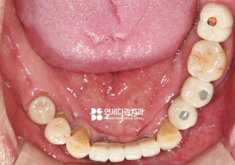 불편한 틀니 임플란트로 바꿔 치료할 수 있을지 가락시장역 치과 에서 살펴봅시다. 관련 이미지 6