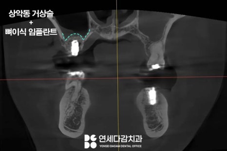 잇몸뼈 없으면 임플란트 수술 못할까? 오금역 연세다감 치과 상악동 거상술 뼈이식 필요한 경우 관련 이미지 4