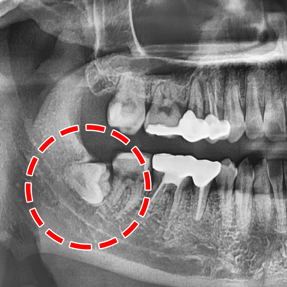 연세다감치과 대표원장의 사랑니 꼭 뽑아야 될까? 통합치의학과 전문의가 알려주는 기준 관련 이미지 3