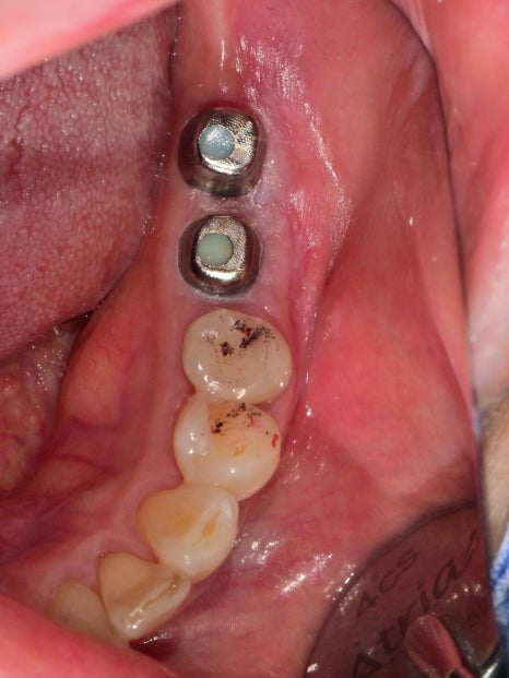 Munjeong-dong Dental Clinic, Bone Graft Implant Process&middot; What If You’ve Lost a Molar? image 10