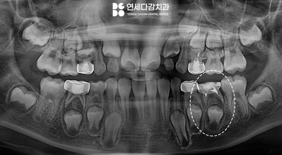 ss크라운 깨졌을 때 다시 제작 가능할까? 송파역 치과 소아 치료 진정요법 없이도 가능했던 이유 관련 이미지 3