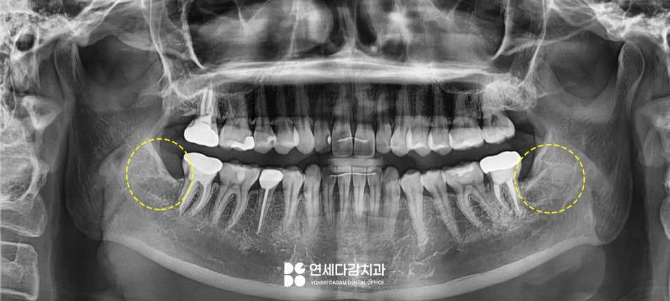 턱관절 통증 송파동 치과 에서 원인 찾고 해결 과정 살펴봅시다.(feat. 초음파 물리치료 및 보톡스 ) 관련 이미지 5