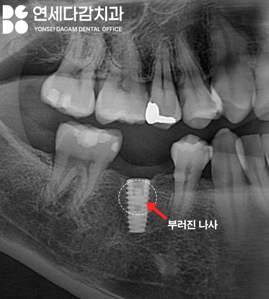 임플란트 빠짐 또는 흔들림 거여역 치과 나사 부러지고 빠졌을 때 재수술 없이 보철 크라운 교체할 수 있는 방법 관련 이미지 5